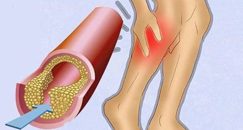 Лечение атеросклероза артерий нижних конечностей: быстро и качественно